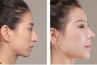 成人脸型矫正手术视频,视频解析与效果展示