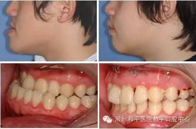 成人脸型矫正手术视频,视频解析与效果展示