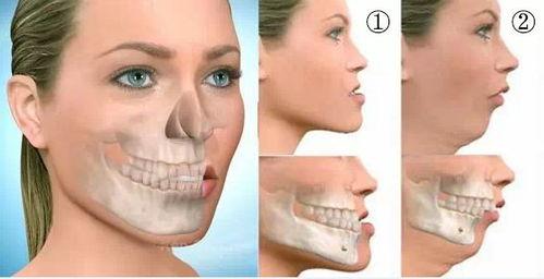 成人脸型矫正手术视频,视频解析与效果展示