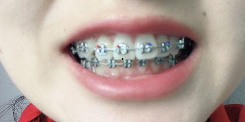 成人磨牙偏方妙招视频,告别夜间磨牙困扰